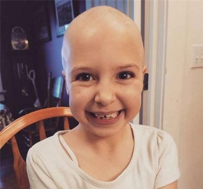 系统性红斑狼疮导致脱发,系统性红斑狼疮患者脱发严重