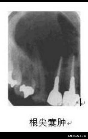 牙齿疼痛难忍吃药后不再疼痛是真的好了吗？事实不是你想的那样！