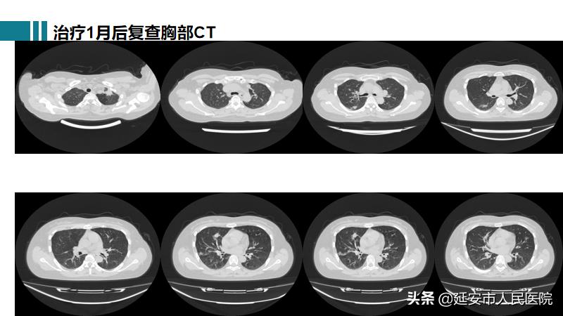 治疗肉芽肿性血管炎哪家医院好,嗜酸性肉芽肿性血管炎哪家医院好
