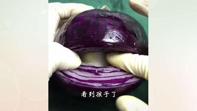 剖腹产手术最重要的步骤,剖腹产要做什么流程