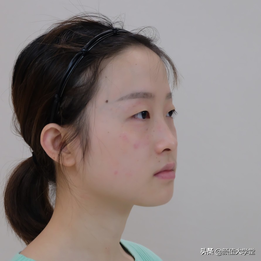 长期贴双眼皮的危害,贴几次双眼皮贴会导致眼皮松弛