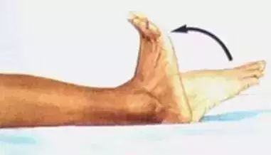 腿上爆青筋是静脉曲张吗,腿上爆出青筋是静脉曲张吗