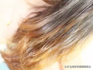 用洗洁精洗头会得银屑病,洗洁精洗头男孩