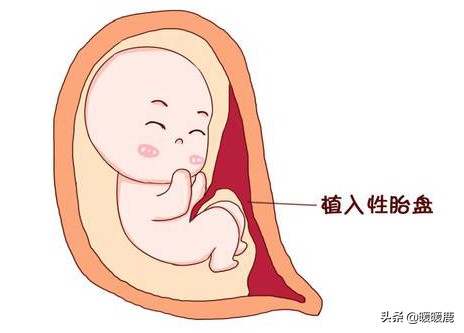 前壁胎盘和前置胎盘有什么区别吗,前壁胎盘跟前置胎盘有什么区别吗