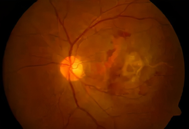 近视的人希望恢复视力吗,干细胞能治高度近视