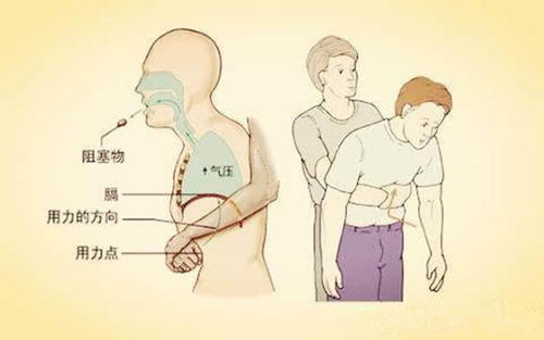 小孩被异物呛进气管症状,小孩气管呛进异物医院怎么处理