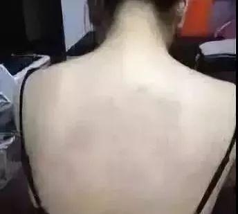 痘痘留下的黑色素可以自己消失吗,瘙痒异味用什么洗