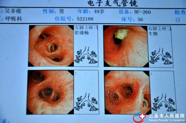 三亚市人民医院成功开展海南省首例支气管镜下冷冻活检术