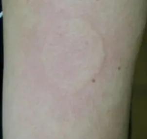 慢性荨麻疹吃什么药,慢性荨麻疹要吃中药调理吗