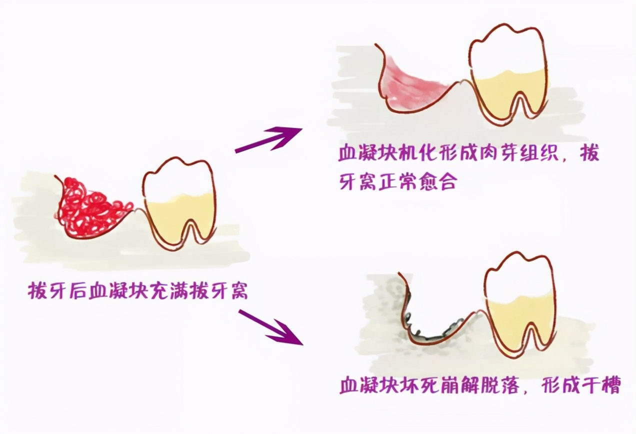 拔牙肿了没有知觉,拔牙后第三天脸肿冰敷还是热敷