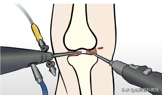 膝盖疼痛半月板损伤怎样锻炼,膝关节半月板损伤疼痛怎样治疗