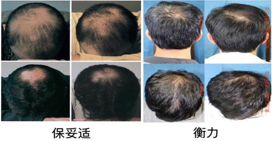 如何挽救脱发,父亲脱发怎么挽救