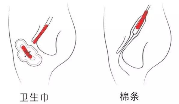 可以预防妇科疾病的姨妈巾,如果选错姨妈巾会有什么危害