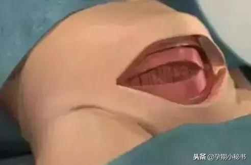 剖腹产最疼的是什么步骤,剖腹产手术步骤详解