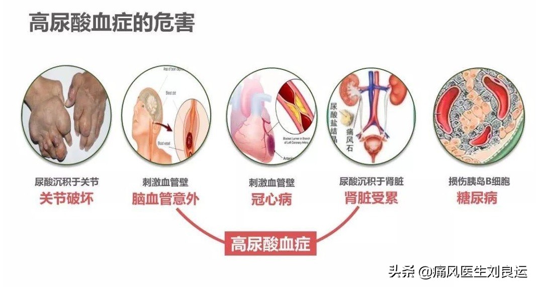 尿酸高对肾造成的伤害会恢复吗,尿酸高对肾有哪些损伤如何治疗
