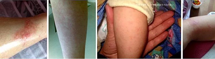 孩子起风疹怎么止痒,孩子疹子的种类