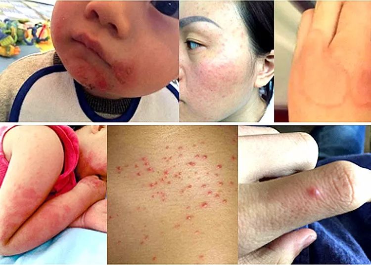 孩子起风疹怎么止痒,孩子疹子的种类