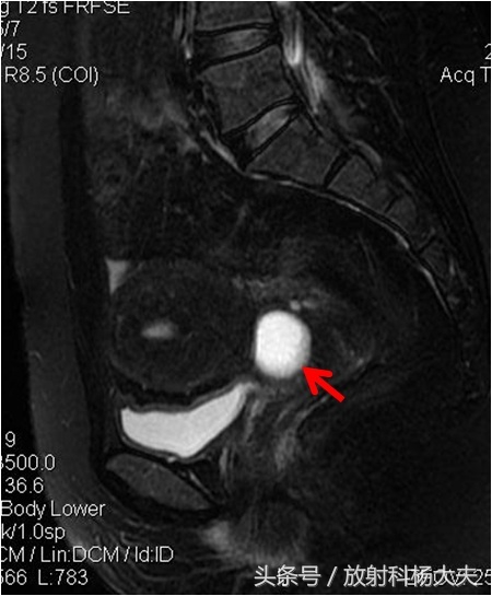 做子宫核磁经常遇到的一种病，大部分女性不知道其根本不用治疗