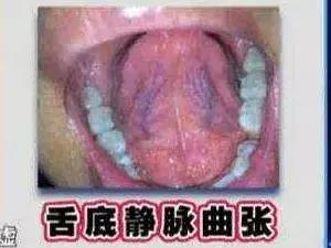 脑梗冠心病,脑梗塞和肝硬化中医调理