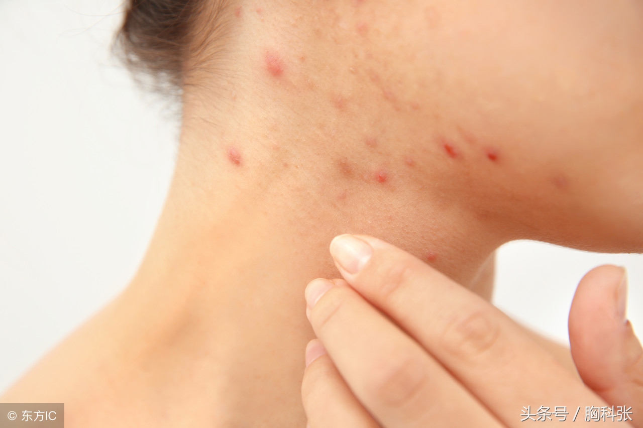 医生胸科张告诉你：遇到药物过敏，我们该怎么办？