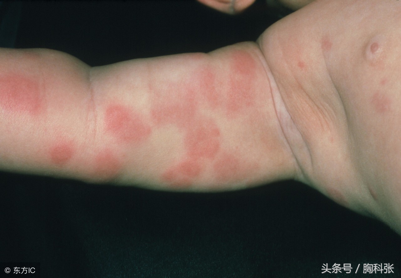 医生胸科张告诉你：遇到药物过敏，我们该怎么办？