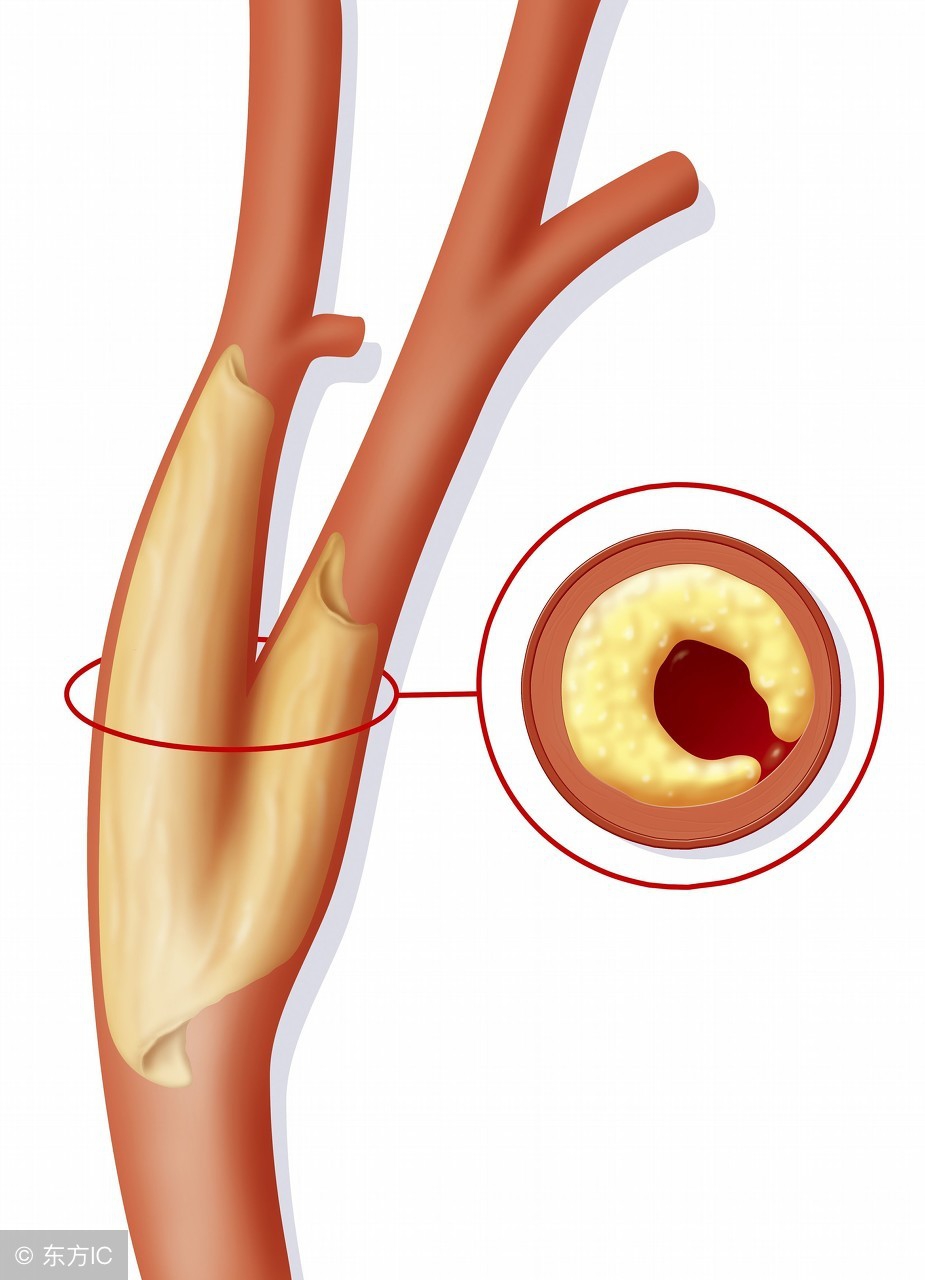 冠状血管阻塞的症状,血管阻塞七大征兆