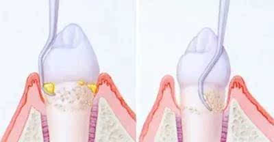 口腔炎会导致牙龈出血么,每天醒来都牙龈出血