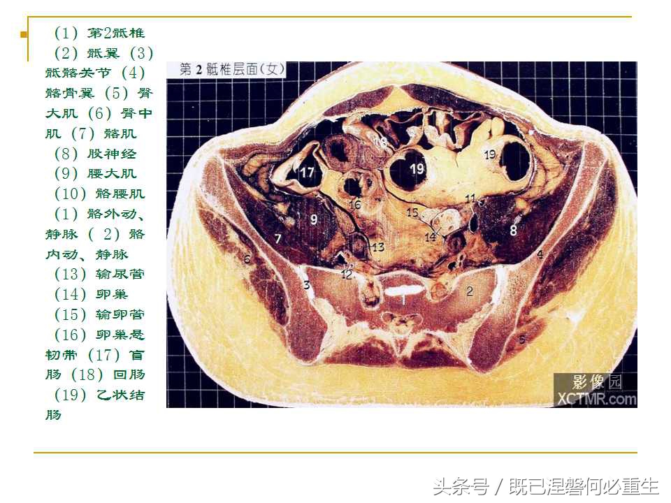 男性盆腔断层解剖图谱,女性盆腔核磁断层解剖