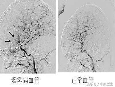 烟雾病生孩子,烟雾病女孩能怀孕生子吗