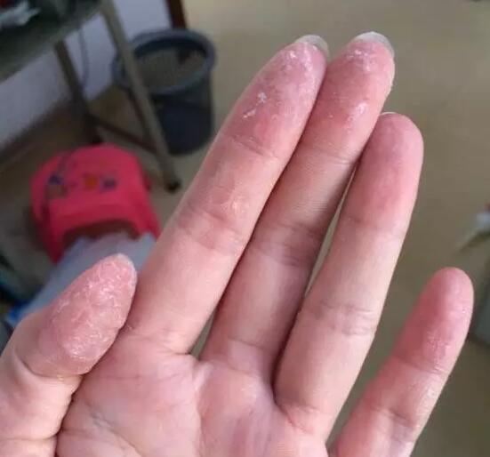 502胶水粘鞋子粘住手了,用502胶水把两个手粘在一起