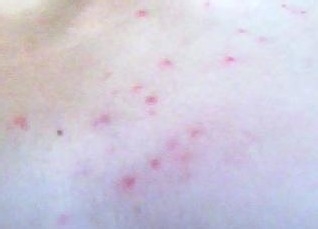 女孩胸前背后长痘6年不敢穿裙子医生竟然这样说