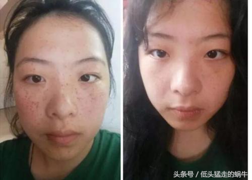 孕妈脸上长痘痘用什么护肤品,孕晚期脸上长斑了怎么消除