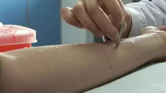 过敏原ige检测查哪些项目,孩子查过敏原有必要么