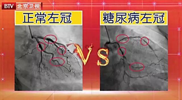 二型糖尿病前期要不要吃药,糖尿病前期没吃药老是觉得饿