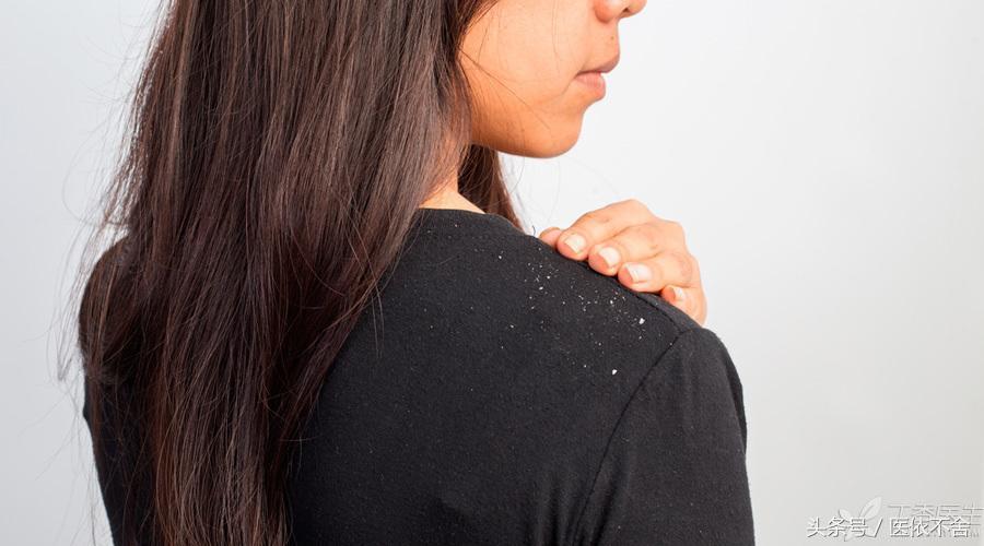 头皮屑突然增多可用什么药洗头发,头皮屑增多的四大原因