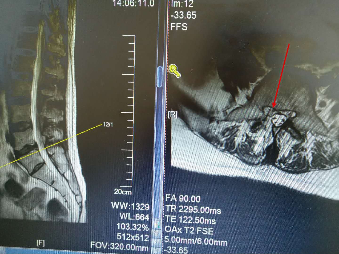 什么叫微创脊柱内镜手术,全可视脊柱内镜技术