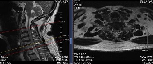 什么叫微创脊柱内镜手术,全可视脊柱内镜技术