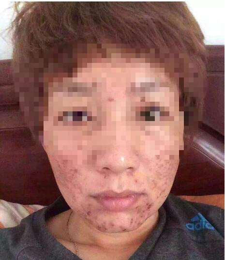 妇科不好脸上会长痘痘怎么办,10岁女孩长痘痘中医该怎么调理