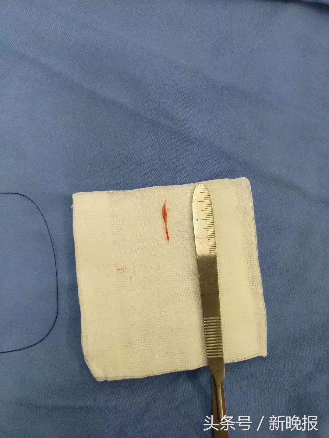 误吞鱼刺，这个习惯性动作很危险！大妈颈部被切开才救回了命