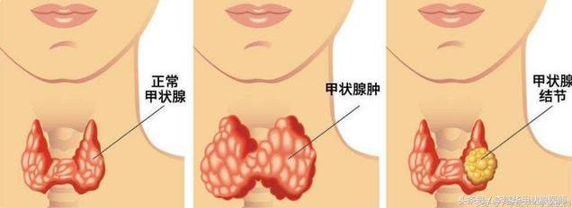 甲状腺结节的饮食和调理方法,甲状腺结节的饮食调理菜谱