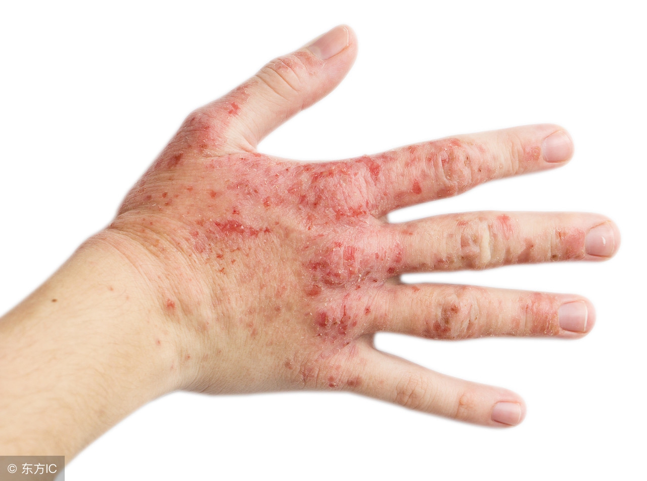 神经性皮炎在饮食上关注什么,得了神经性皮炎吃什么口服药