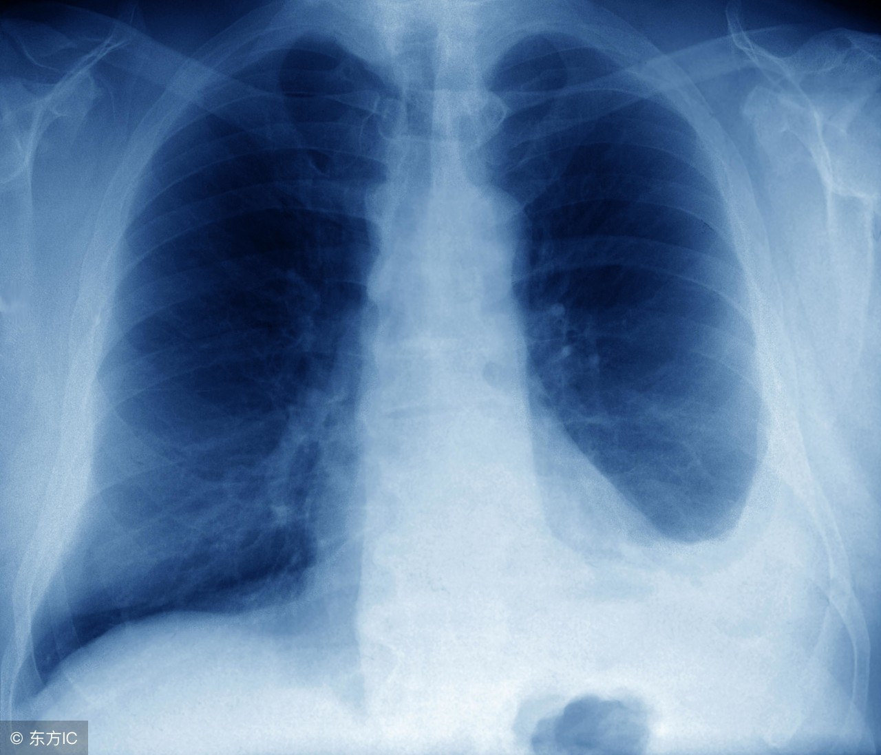 结肠癌骨转移的最佳治疗方法,结肠癌骨转移疼痛如何缓解