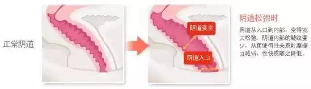 私密保养：真实的需要，请不要害羞！——益阳现代妇女儿童医院