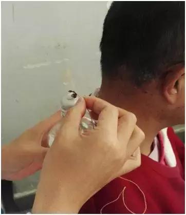 深圳点灸治疗带状疱疹,火灸疗法治疗带状疱疹