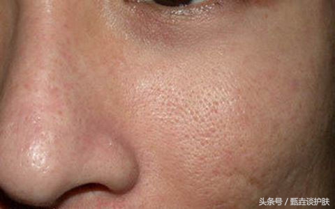 如何真正改善毛孔粗大,毛孔粗大油腻如何改善