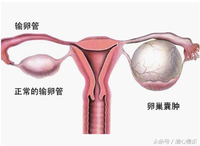 月经期间跑步卵泡破裂,大姨妈期间跑步黄体会破裂吗