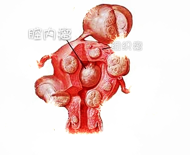 左小腹疼痛阴道流血是什么症状,下腹隐痛要警惕四种病白带多