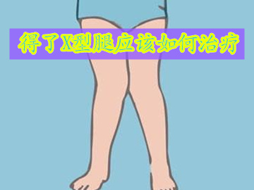 盘腿坐治疗x型腿,世界公认矫正x型腿最有效的方法