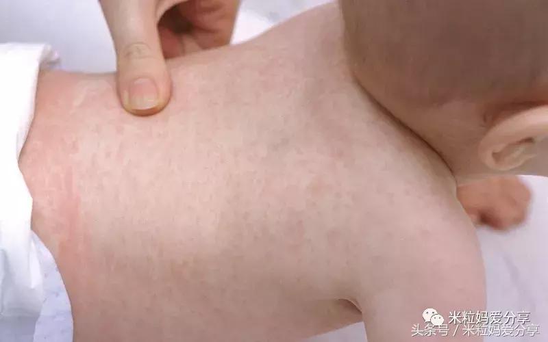 宝宝起疹的最佳治疗方法,孩子发烧后出疹怎么护理