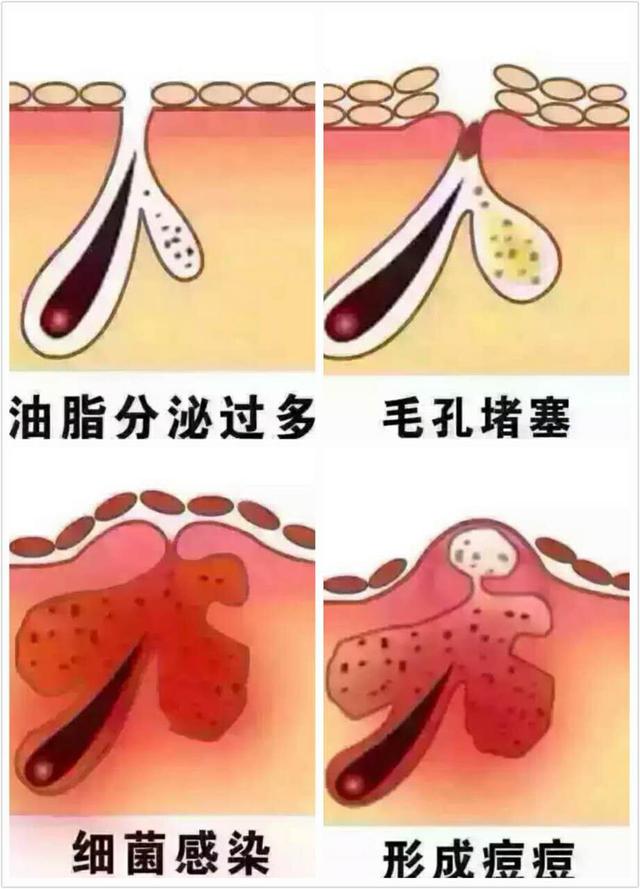 激素脸有多可怕,激素脸怎么办最快最有效的方法